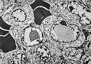 M,62y. | plasmocytoma - nasal cavity